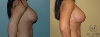 Before and after Breast Implant Exchange or Removal case 35125 - Angle 2