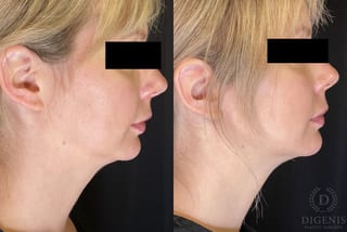 Before and after Injectables (Botox, Dysport, Jeuveau) case 35126 - Angle 1