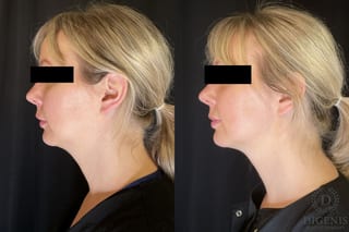 Before and after Injectables (Botox, Dysport, Jeuveau) case 35126 - Angle 2