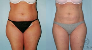 Before and after Liposuction case 35127 - Angle 1