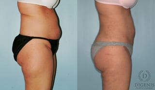 Before and after Liposuction case 35127 - Angle 2
