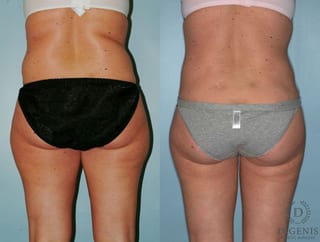 Before and after Liposuction case 35127 - Angle 4