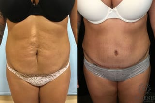 Before and after Tummy Tuck case 35128 - Angle 1