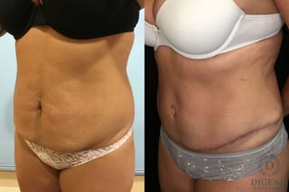 Before and after Tummy Tuck case 35128 - Angle 2