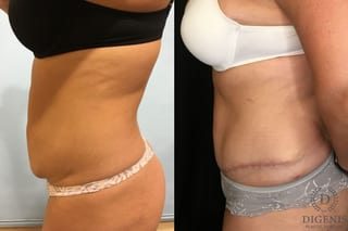 Before and after Tummy Tuck case 35128 - Angle 3