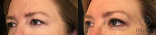 Before and after Eye Lid Surgery case 35129 - Angle 1