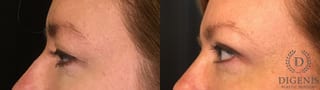 Before and after Eye Lid Surgery case 35129 - Angle 3