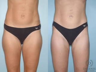 Before and after Liposuction case 35130 - Angle 1