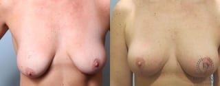 Before and after Breast Lift with or without Implants case 35132 - Angle 1