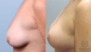 Before and after Breast Lift with or without Implants case 35132 - Angle 5