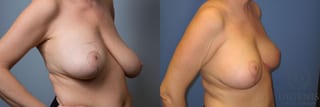 Before and after Breast Lift with or without Implants case 35133 - Angle 2