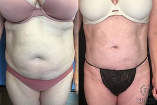 Before and after Liposuction case 35134 - Angle 1