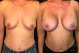 Before and after Breast Augmentation case 35136 - Angle 1