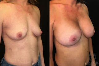 Before and after Breast Augmentation case 35136 - Angle 2