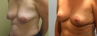 Before and after Breast Lift with or without Implants case 35140 - Angle 2