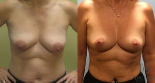 Before and after Breast Lift with or without Implants case 35140 - Angle 1
