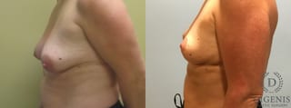 Before and after Breast Lift with or without Implants case 35140 - Angle 5