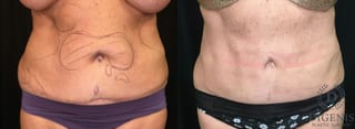 Before and after Liposuction case 35142 - Angle 1