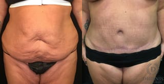 Before and after Tummy Tuck case 35143 - Angle 1
