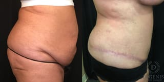 Before and after Tummy Tuck case 35143 - Angle 3