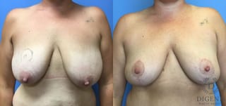 Before and after Breast Lift with or without Implants case 35144 - Angle 1