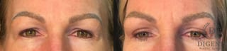 Before and after Eye Lid Surgery case 35145 - Angle 1