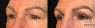 Before and after Eye Lid Surgery case 35145 - Angle 4