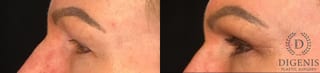Before and after Eye Lid Surgery case 35145 - Angle 5