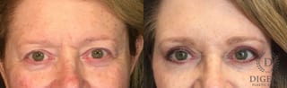 Before and after Eye Lid Surgery case 35146 - Angle 1