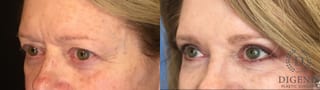 Before and after Eye Lid Surgery case 35146 - Angle 4
