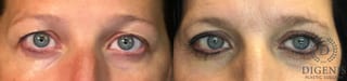 Before and after Eye Lid Surgery case 35147 - Angle 1