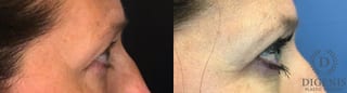 Before and after Eye Lid Surgery case 35147 - Angle 3