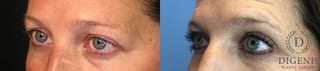 Before and after Eye Lid Surgery case 35147 - Angle 4
