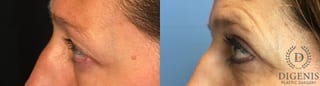 Before and after Eye Lid Surgery case 35147 - Angle 5