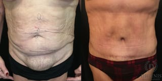 Before and after Tummy Tuck case 35148 - Angle 1