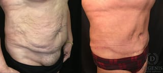 Before and after Tummy Tuck case 35148 - Angle 2