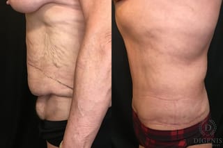 Before and after Tummy Tuck case 35148 - Angle 5