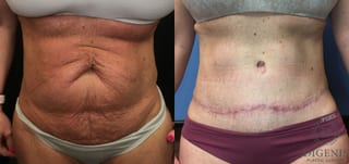 Before and after Tummy Tuck case 35149 - Angle 1