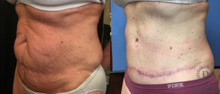 Before and after Tummy Tuck case 35149 - Angle 4