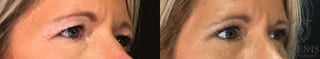 Before and after Eye Lid Surgery case 35150 - Angle 2