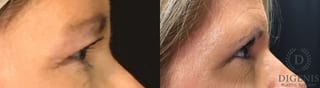 Before and after Eye Lid Surgery case 35150 - Angle 3