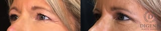 Before and after Eye Lid Surgery case 35150 - Angle 4