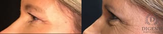 Before and after Eye Lid Surgery case 35150 - Angle 5