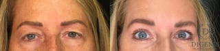 Before and after Eye Lid Surgery case 35151 - Angle 1