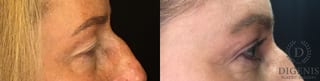Before and after Eye Lid Surgery case 35151 - Angle 3