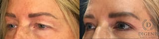 Before and after Eye Lid Surgery case 35151 - Angle 4