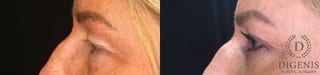 Before and after Eye Lid Surgery case 35151 - Angle 5