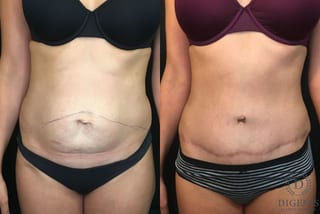 Before and after Tummy Tuck case 35152 - Angle 1