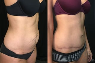 Before and after Tummy Tuck case 35152 - Angle 2