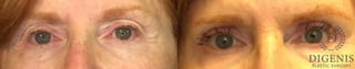 Before and after Eye Lid Surgery case 35153 - Angle 1